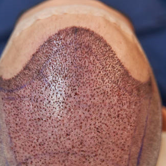 hairtransplant   Saudia